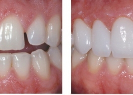 Bọc răng sứ Cercon tự tin hơn với hàm răng trắng bóng