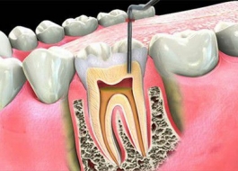 Điều trị tủy răng loại bỏ hoàn toàn viêm nhiễm chỉ trong 1 lần duy nhất