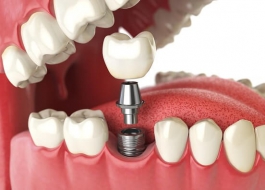 Cấy ghép Implant là gì? – Giải pháp tối ưu khắc phục mất răng