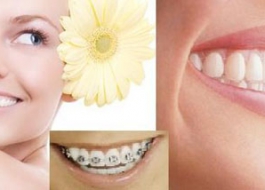 4 cách chăm sóc răng sau khi niềng răng