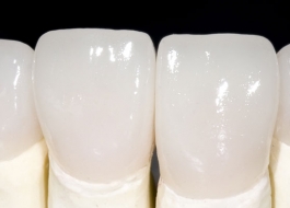 Răng sứ Zirconia giải pháp giúp phục hình răng đẹp lung linh